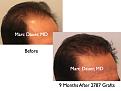 Click image for larger version

Name:	Hair Transplant Slides1.284.jpg
Views:	285
Size:	60.5 KB
ID:	469360