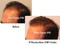 Click image for larger version

Name:	Hair Transplant Slides1.283.jpg
Views:	309
Size:	59.5 KB
ID:	469361