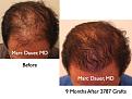 Click image for larger version

Name:	Hair Transplant Slides1.285.jpg
Views:	310
Size:	76.9 KB
ID:	469362