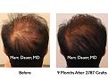 Click image for larger version

Name:	Hair Transplant Slides1.286.jpg
Views:	315
Size:	66.0 KB
ID:	469363