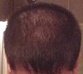 Click image for larger version

Name:	Hairloss.JPG
Views:	469
Size:	51.8 KB
ID:	469430