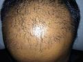 Click image for larger version

Name:	post_op_40_days.jpg
Views:	358
Size:	96.2 KB
ID:	469472