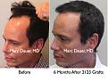Click image for larger version

Name:	Hair Transplant Slides2.288.jpg
Views:	303
Size:	75.2 KB
ID:	469518
