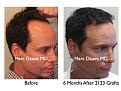 Click image for larger version

Name:	Hair Transplant Slides2.289.jpg
Views:	208
Size:	74.5 KB
ID:	469519