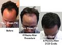 Click image for larger version

Name:	Hair Transplant Slides2.290.jpg
Views:	297
Size:	68.5 KB
ID:	469520