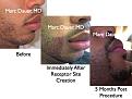 Click image for larger version

Name:	Hair Transplant Slides2.271.jpg
Views:	2172
Size:	75.8 KB
ID:	469522