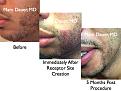 Click image for larger version

Name:	Hair Transplant Slides2.272.jpg
Views:	2818
Size:	80.2 KB
ID:	469523