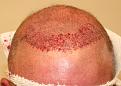 Click image for larger version

Name:	ms immediate post-op front.jpg
Views:	629
Size:	85.7 KB
ID:	469552