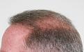 Click image for larger version

Name:	ms 1 yr post-op R profile.jpg
Views:	492
Size:	89.0 KB
ID:	469557