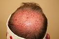 Click image for larger version

Name:	ms immediate post-op back.jpg
Views:	651
Size:	91.6 KB
ID:	469559