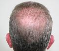 Click image for larger version

Name:	ms 1 yr post-op back.jpg
Views:	555
Size:	89.3 KB
ID:	469560