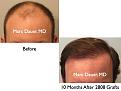 Click image for larger version

Name:	Hair Transplant Slides1.312.jpg
Views:	311
Size:	57.3 KB
ID:	469562