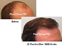 Click image for larger version

Name:	Hair Transplant Slides1.314.jpg
Views:	300
Size:	64.7 KB
ID:	469564