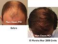 Click image for larger version

Name:	Hair Transplant Slides1.315.jpg
Views:	304
Size:	71.7 KB
ID:	469565