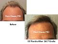 Click image for larger version

Name:	Hair Transplant Slides2.321.jpg
Views:	339
Size:	64.2 KB
ID:	469644