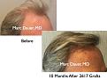 Click image for larger version

Name:	Hair Transplant Slides2.320.jpg
Views:	321
Size:	73.6 KB
ID:	469646