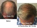 Click image for larger version

Name:	Hair Transplant Slides2.318.jpg
Views:	236
Size:	91.3 KB
ID:	469647