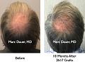 Click image for larger version

Name:	Hair Transplant Slides2.316.jpg
Views:	245
Size:	91.8 KB
ID:	469648