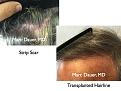 Click image for larger version

Name:	Hair Transplant Slides2.317.jpg
Views:	233
Size:	90.0 KB
ID:	469649