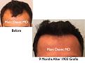Click image for larger version

Name:	Hair Transplant Slides5.322.jpg
Views:	369
Size:	61.7 KB
ID:	469703