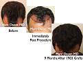 Click image for larger version

Name:	Hair Transplant Slides5.323.jpg
Views:	400
Size:	70.8 KB
ID:	469704