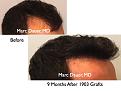 Click image for larger version

Name:	Hair Transplant Slides5.325.jpg
Views:	275
Size:	67.6 KB
ID:	469705