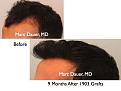 Click image for larger version

Name:	Hair Transplant Slides5.324.jpg
Views:	353
Size:	62.1 KB
ID:	469706