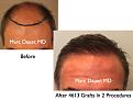 Click image for larger version

Name:	Hair Transplant Slides4.329.jpg
Views:	387
Size:	61.4 KB
ID:	469731