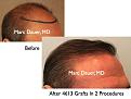 Click image for larger version

Name:	Hair Transplant Slides4.331.jpg
Views:	392
Size:	70.3 KB
ID:	469732