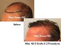 Click image for larger version

Name:	Hair Transplant Slides4.330.jpg
Views:	371
Size:	66.7 KB
ID:	469733