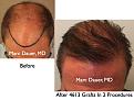 Click image for larger version

Name:	Hair Transplant Slides4.332.jpg
Views:	467
Size:	79.1 KB
ID:	469734
