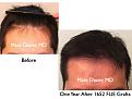 Click image for larger version

Name:	Hair Transplant Slides8.335.jpg
Views:	593
Size:	69.4 KB
ID:	469756