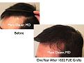 Click image for larger version

Name:	Hair Transplant Slides8.336.jpg
Views:	332
Size:	61.5 KB
ID:	469757
