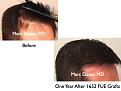 Click image for larger version

Name:	Hair Transplant Slides8.337.jpg
Views:	362
Size:	64.5 KB
ID:	469758