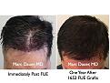 Click image for larger version

Name:	Hair Transplant Slides8.338.jpg
Views:	394
Size:	84.5 KB
ID:	469759