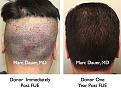 Click image for larger version

Name:	Hair Transplant Slides8.339.jpg
Views:	338
Size:	93.2 KB
ID:	469760