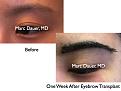 Click image for larger version

Name:	Hair Transplant Slides3.345.jpg
Views:	614
Size:	61.4 KB
ID:	469761