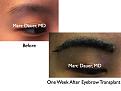 Click image for larger version

Name:	Hair Transplant Slides3.344.jpg
Views:	1165
Size:	59.7 KB
ID:	469762
