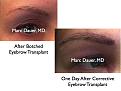 Click image for larger version

Name:	Hair Transplant Slides2.334.jpg
Views:	444
Size:	61.2 KB
ID:	469803