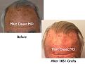 Click image for larger version

Name:	Hair Transplant Slides6.352.jpg
Views:	400
Size:	66.3 KB
ID:	469812
