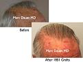Click image for larger version

Name:	Hair Transplant Slides6.350.jpg
Views:	289
Size:	70.2 KB
ID:	469813