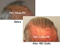 Click image for larger version

Name:	Hair Transplant Slides6.350.jpg
Views:	382
Size:	70.2 KB
ID:	469813