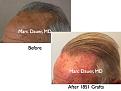 Click image for larger version

Name:	Hair Transplant Slides6.351.jpg
Views:	367
Size:	72.4 KB
ID:	469814