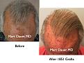 Click image for larger version

Name:	Hair Transplant Slides6.349.jpg
Views:	394
Size:	84.4 KB
ID:	469815