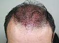 Click image for larger version

Name:	lc immediate post-op chin down .jpg
Views:	333
Size:	92.6 KB
ID:	469840