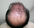 Click image for larger version

Name:	lc immediate post-op chin up (2).jpg
Views:	330
Size:	94.7 KB
ID:	469843
