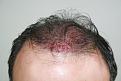 Click image for larger version

Name:	lc immediate post-op front.jpg
Views:	341
Size:	90.6 KB
ID:	469846