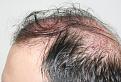Click image for larger version

Name:	lc immediate post-op L profile.jpg
Views:	327
Size:	98.1 KB
ID:	469848