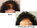 Click image for larger version

Name:	Hair Transplant Slides7.357.jpg
Views:	292
Size:	69.5 KB
ID:	469872