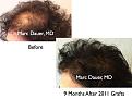 Click image for larger version

Name:	Hair Transplant Slides7.358.jpg
Views:	282
Size:	71.6 KB
ID:	469873